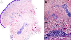 Pathology images. A, Panoramic image showing superficial and deep perivascular and periadnexal infiltrate (hematoxylin-eosin [HE], original magnification ×20). B, Higher magnification image showing perineural infiltrate (HE, original magnification ×40). C, Detail of the inflammatory infiltrate, which consists of plasma cells.