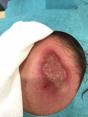 Cutaneous leishmaniasis. Solitary, indurated, crusty plaque on the forehead.