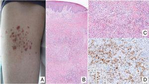 A, Papules at different stages of development corresponding to lymphomatoid papulosis (LP). B, Dermal infiltrate formed of atypical lymphocytes and rich in eosinophils from a papular LP lesion. C, Large-cell lymphocytes with nuclear pleomorphism in an LP lesion. D, Expression of CD30 antigen in large lymphocytes with an activated appearance in LP.