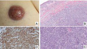 A, Primary cutaneous CD30+ anaplastic large-cell lymphoma. B, Diffuse dermal infiltrate of atypical lymphoid cells. C, Atypical lymphoid cells with pleomorphic nuclei. D, Expression of CD30 antigen in most of the cells of the infiltrate.