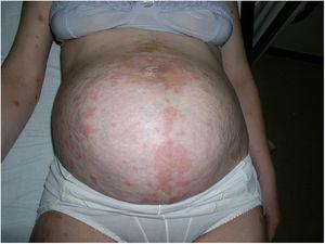 Highly pruritic erythematous plaques on the abdomen.