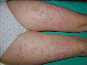 Pruritic erythematous plaques with small blisters affecting both lower extremities.