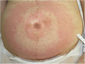 Bullseye-like erythematous, edematous plaques and vesicles on the abdomen.