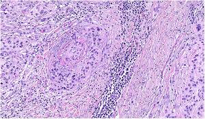 Melanoma cells in perivascular space (angiotropism). Hematoxylin-eosin, original magnification ×400.