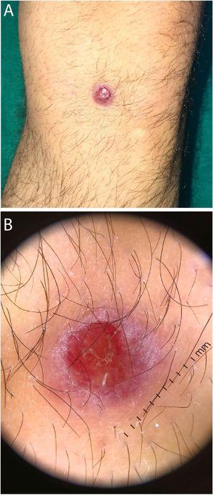 Violaceous, round and indurated lesion, with central erosion and peripheral desquamation (A). Dermatoscopy showed vessels with a crown distribution and central yellowish scales (B).