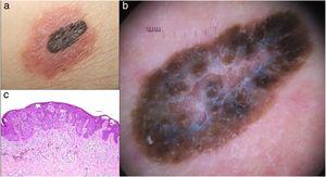 (a) Central pigmented lesion and surrounding eczematous halo. (b) Dermoscopy revealing central pigmented dark brown-black atypical and irregular lesion with a blue-white veil in the center surrounded by erythema and scarce dotted vessels within the halo. (c) Histopathologic appearance of Meyerson phenomenon within a melanoma. Intraepidermal atypical, confluent melanocytic proliferation. Mild spongiosis, epidermal acantosis and chronic inflammatory cell infiltrate. (Hematoxylin-eosin stain; original magnification: ×20).