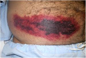 Large purpuric plaque with a necrotic central area on the abdomen of a patient receiving bemiparin sodium for anticoagulation.