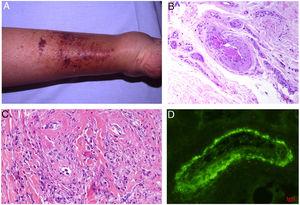 A, Cryoglobulinemia with multiple purpuric papules near the ankle, with hemorrhagic skin discoloration. B, Type I cryoglobulinemia, showing an intravascular hyaline mold partially occluding the vessel. Hematoxylin-eosin, magnification ×100. C, In mixed cryoglobulinemia, a skin sample shows vessels with fibrinoid necrosis in the reticular dermis, vascular subocclusion, leukocytoclasia, and endothelial necrosis. Hematoxylin-eosin, magnification ×200. D, In cryoglobulinemia, immunoglobulin G deposits are detected in the inflamed vessel wall. Direct immunofluorescence, magnification ×200.