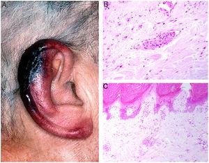 A, In cryofibrinogenemia, erythematous-purpuric lesions have formed on the outer ear, especially the lobe and helix, where necrosis has developed. B, In cold agglutinin disease, intraluminal thrombi are aggregates of red blood cells, fibrin, and polymorphonuclear neutrophils. Hematoxylin-eosin (H&E), magnification ×200. C, Necrosis of the overlying epidermis and occlusion of vessels in the superficial dermis in cold agglutinin disease. H&E, magnification ×100.