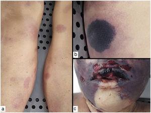 Photographs taken during an autopsy of a patient with severe neutropenia and ecthyma gangrenosum secondary to sepsis due to Pseudomonas aeruginosa. The lesions shown are in various stages of the disease: A, Initial erythematous macules on the legs. B, A more advanced lesion with a blackish center and an erythematous border. C, Necrotic bullae on the face.
