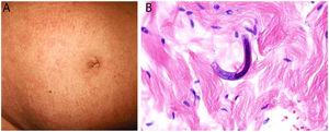 A, Purpuric lesions on the abdomen of an immunocompromised patient with disseminated strongyloidiasis. B, Strongyloides stercoralis larvae among dermal collagen bundles. Hematoxylin-eosin, magnification ×60.