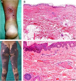 A, Ulcer secondary to hydroxyurea therapy. Photograph courtesy of Dr Fernando Cabo, Dermatology Department, Hospital Universitario de Ourense, Spain. B, In vasculopathy syndrome associated with use of levamisole-laced cocaine, note the intravascular occlusion by fibrin thrombi without vasculitis. Also note the extravasation of red cells and lack of epidermal necrosis. Hematoxylin-eosin (H&E), magnification × 40. C, Confluent purpuric lesions affecting large areas of the lower extremities and buttocks. D, In vasculopathy syndrome associated with use of levamisole-laced cocaine at higher magnification, note the intravascular occlusion with extravasated red cells but without vasculitis. No epidermal necrosis is present. H&E, magnification × 100.