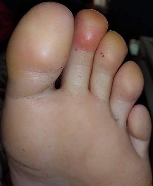 Typical image of chilblains that was common to all patients.