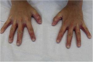 Similar lesions on the sides and dorsa of the hands.