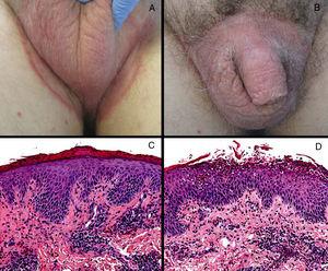 Clinical and histologic findings. A, Erythematous plaque with well-defined borders in the pubic area. B, Scrotal erythematous plaque affecting both sides of the groin area, with a more pronounced erythematous scaling border. C, Epidermal acanthosis with extensive parakeratosis and a perivascular lymphocytic infiltrate (hematoxylin-eosin, original magnification ×200). D, Epidermal acanthosis with neutrophilic spongiosis and perivascular lymphocytic dermal infiltrates with eosinophils (hematoxylin-eosin, original magnification ×200).