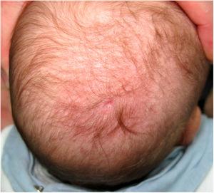 Membranous aplasia cutis congenita. Erythematous alopecic plaque with a diameter of 8 mm on the vertex of the scalp.