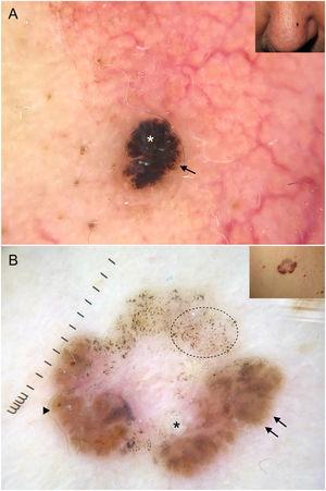 Basal cell carcinomas with features of melanocytic lesions. A, Strongly pigmented 3-mm lesion with a blue-white veil (white asterisk) and brown globules (black arrow). B, Multicomponent pattern in a basal cell carcinoma in regression: multiple gray dots (circle with dotted line), projections (black arrows), maple leaf–like areas (triangle), and milia-like cyst (asterisk); shiny white structures and polymorphous vascularization.