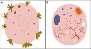 Schematic representation of dermoscopic features of superficial and nonsuperficial basal cell carcinoma. A, Superficial basal cell carcinoma: maple leaf–like structures, spoke-wheel structures, concentric structures, multiple erosions, and short fine telangiectasias. B, Nonsuperficial basal cell carcinoma: arborizing telangiectasias, blue-gray ovoid nest, multiple blue-gray dots and globules, ulceration, and whitish structures.