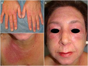 Skin lesions prior to beginning tofacitinib therapy. A, Gottron papules, periungual erythema, and hemorrhagic crusting on the hands. B, Facial erythema and scaling and heliotrope erythema of the eyelids. C, V sign on the chest.