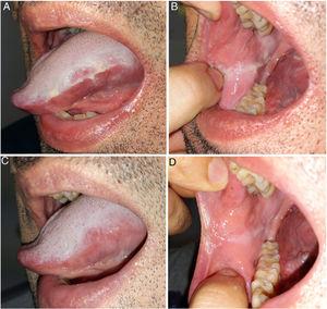 Wrinkled, whitish lesions on the sides of the tongue (A) and on the buccal mucosa (B). Clinical improvement of the lesions on the side of the tongue (C) and on the buccal mucosa (D) after treatment with oral doxycycline.