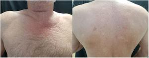 A, Increased skin stiffness on the chest with papules and peau d’orange in a V-shaped pattern. B, Waxy stiffness of the skin of the back.