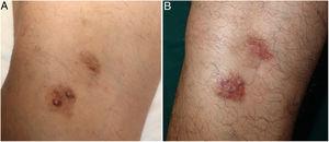 A, Brownish plaques with superficial papules located on the left popliteal fossa. B, After biopsy the plaques acquired a more erythematous appearance, but remained stable.