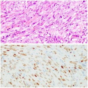Histological examination characteristic of Kaposi sarcoma (hematoxylin-eosin stain; x400 magnification) and immunohistochemical staining for HHV8 (x400 magnification).