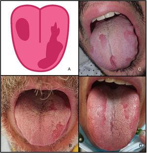 Glossitis and patchy depapillation (3.9%) in patients with COVID-19. A, Illustration showing glossitis with patchy depapillation observed in patients with COVID-19. B–D, Patients with glossitis and patchy depapillation. Fungal culture and serology were negative. COVID-19 indicates coronavirus disease 2019.
