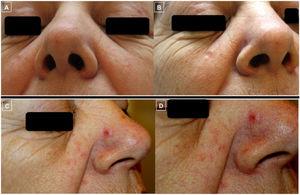 Clinical photographs showing the course of the lesions (A-D). Photographs A and B show the good response of the lesions on both cheeks following treatment with intralesional rituximab. Photographs C and D, however, show worsening and the appearance of a clearly demarcated erythematous papule on the side of the nose (D) on skin with a tendency to redness and presence of telangiectases on the cheeks and tip of the nose, giving a rosaceaform appearance.