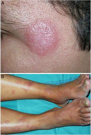 Leprosy. A, Erythematous, well-demarcated tuberculoid leprosy on the left temple of a young Paraguayan man. B, Dimorphic leprosy. Disseminated erythematous macules, some with an annular shape, on the legs of a middle-aged Filipino woman with dimorphic leprosy.