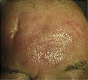 Morbihan disease. Erythematous-edematous lesion on the forehead. gr3.