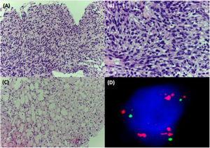 Histology and fluorescence in situ hybridization (FISH). A, B, Staining with hematoxylin-eosin showing a proliferation of neoplastic spindle-shaped cells. C, Focal areas with adipocyte differentiation. D, FISH showing MDM2 amplification on the right arm of chromosome 12.