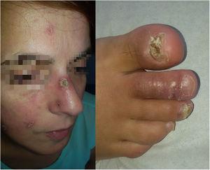 Erythematous lupus pernio lesions on the face with crusts on the surface. Dactylitis in 3 toes of the right foot associated with nail disease.