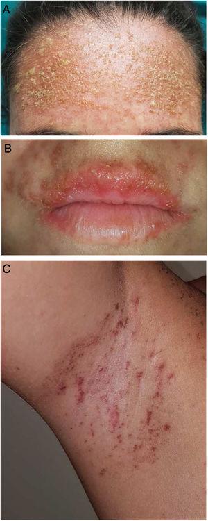 A, Erythematous, crusting rash with pustules on the forehead. B, Multiple vesicles on the area of the lips. C, Ecchymotic maculopapular rash on the axilla.
