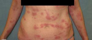 Lesions exhibiting the comet sign on the abdomen of Patient 2.