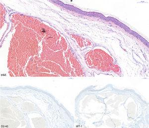Histological images showing (A) thin-walled vascular lumina (hematoxylin–eosin staining) and (B) negative staining for D2-40 and WT-1.