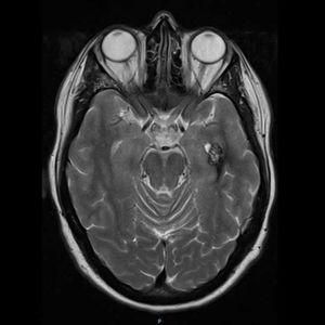 Magnetic resonance imaging of the brain of one of the patient’s daughters showing a popcorn-like image compatible with cerebral cavernous malformation.