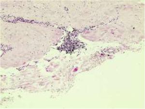 Multiple keloid-like skin nodules on the chest.