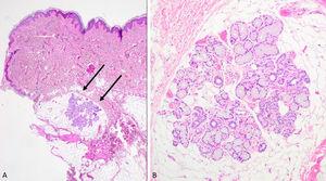 In subcutaneous cellular tissue, aggregates of salivary gland tissue made up of mucous and serous glands.