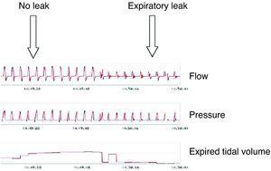 Simulation model with unidirectional valve that shows how a system would behave if it monitored the expired tidal volume in a patient with ventilation with nasal interface and expiration through the mouth. Despite the fact that the inspiratory volume provided by the ventilator is the same, the monitored value drops significantly.