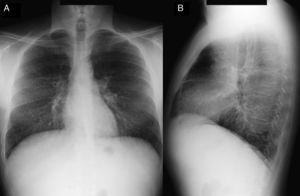 Chest radiograph, with posteroanterior (A) and lateral (B) projections. Reticular pattern seen predominantly in the bases.
