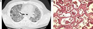 (A) A mellkasi CT-n megfigyelt diffúz interstitialis infiltrátum mindkét tüdőben. (B) Interstitialis gyulladás és fibrózis erős nagyításban bronchiolitis interstitialis pneumonitisben.