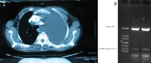 Massive left pleural effusion on chest CT.