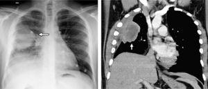 On the left, chest radiography presenting a homogenous lung mass with well-defined edges in the upper right lobe (white arrow), in contact with the pleura and associated with the loss in volume. On the right, in the computed tomography (CT) coronal reconstruction with soft-tissue window, the well-defined mass can be observed with areas of central necrosis in contact with the pleura and producing thickening, as well as the loss in volume of the right hemithorax.