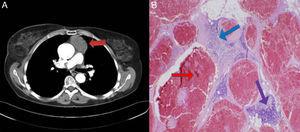 (A) The thoracoabdominal computed tomography shows the existence of a prevascular soft tissue mass (red arrow). (B) The anatomopathologic study of the surgical piece demonstrates dilated vascular channels full of blood and covered with flat endothelial cells without atypia (red arrow), fibrous septa that cross the lesion (blue arrow) and thymic tissue that is normal in appearance in the periphery (purple arrow), compatible with thymic cavernous hemangioma.