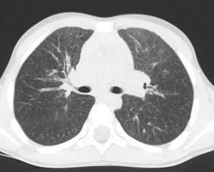 Chest CT scan repeated years later (twin number 1).