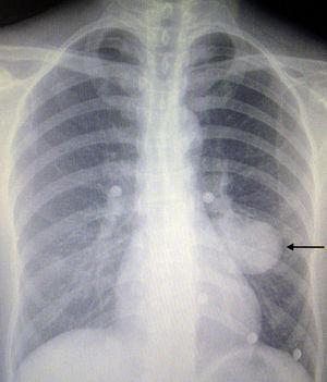 Pneumocitoma no hemitórax esquerdo no raio X (seta).