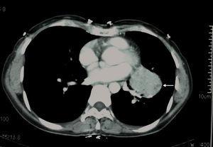 gauche emplacement infrahilar sur la poitrine CT scan (flèche).