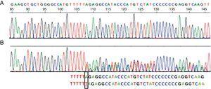 Sequence corresponding to exon 5 SERPINA1. (A) Normal sequence. (B) Sequence corresponding to the patient, which shows insertion of a thymine (T) instead of an adenine (A) at codon 376 in exon 5 of heterozygosity for the PI-Mattawa allele. The SERPINA1 gene coding sequence (exons 2–5) was analyzed using previously described primers for exons 3–5 and 5′ACGTGGTGTCAATCCCTGATCACTG3′ Ex2F primers and ex2R 5′TATGGGAACAGCTGG3′ for exon 2, with reference to the comparative SERPINA1_Transcript_ENST00000440909.