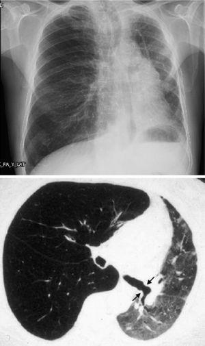 Chest X-ray and chest CT of a patient with left unilateral lung transplant due to COPD.